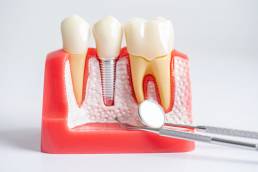 Hybrid Dental Implants and Their Advantages