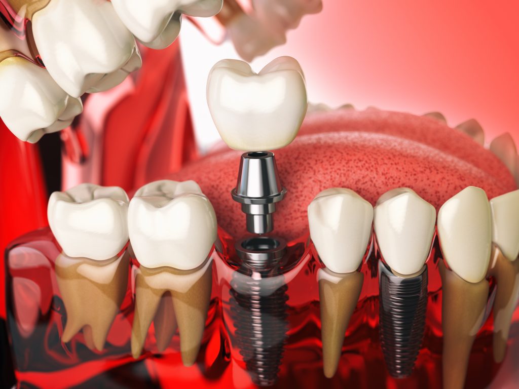Advantages of All-On-X Dental Implants for Your Dental Patients