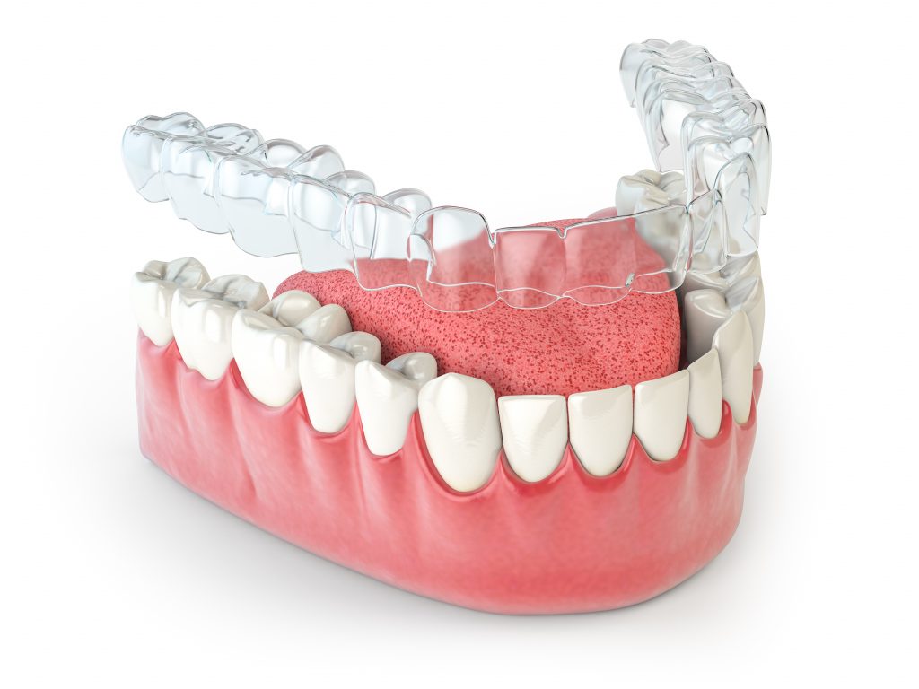 How Does Invisalign Work?