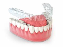 How Does Invisalign Work?