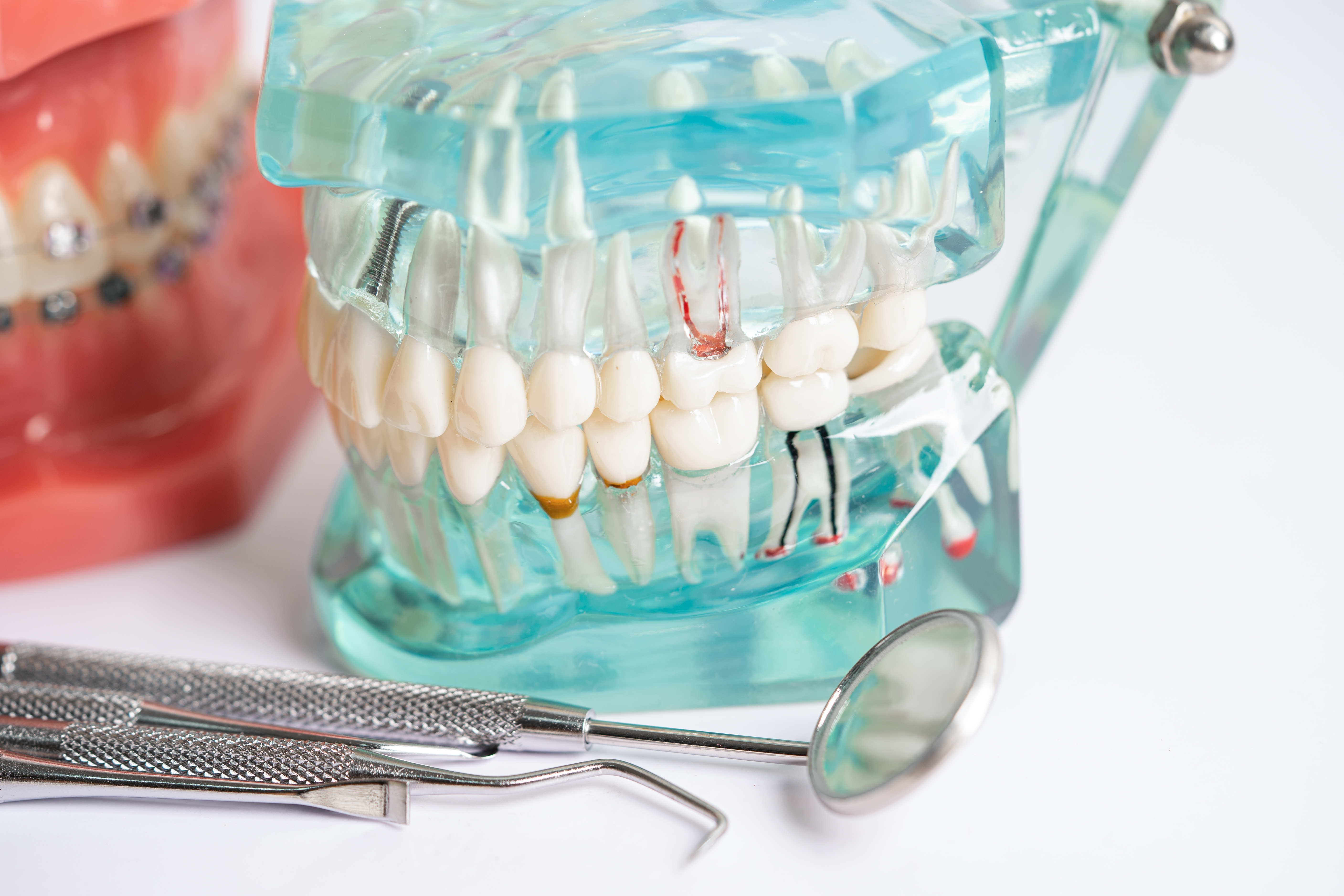 Why All-on-X Implants Are the Best Solution for Full-Arch Tooth Replacement?