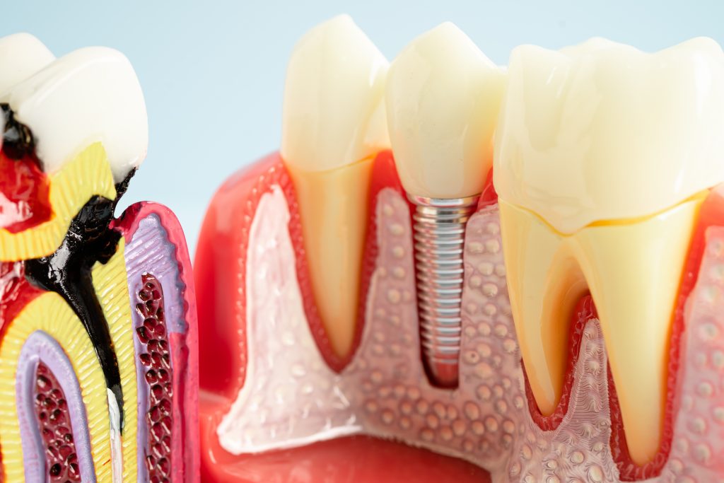Zirconia vs. E.max vs. PFM: How to Choose the Best Crown Material