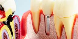 Zirconia vs. E.max vs. PFM: How to Choose the Best Crown Material