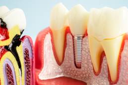 Zirconia vs. E.max vs. PFM: How to Choose the Best Crown Material