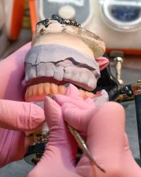 Introduction: The Importance of Precision in Full-Arch Restorations Full-arch implant restorations are among the most rewarding yet demanding treatments in dentistry. Precision is critical because even the smallest misfit can compromise occlusion, esthetics, or implant longevity. Unlike single-unit crowns, full-arch cases involve multiple implants, complex occlusal forces, and high esthetic expectations. This is why labs play a central role, their ability to combine digital workflows, material expertise, and functional design directly impacts the predictability of treatment. Common Challenges in Full-Arch Implant Cases Full-arch restorations often face: Implant misalignment due to surgical inaccuracies. Occlusal discrepancies that cause fractures or discomfort. Acrylic fractures or wear in hybrid prostheses. Esthetic challenges, especially with lip support and smile line. Remakes and extended chair time when frameworks don’t fit. In Minnesota labs, technicians note that many of these issues arise from incomplete case information or a lack of synchronization between the surgical and restorative teams. The Role of the Dental Lab in Ensuring Accurate Fit The lab is not just a manufacturer; it’s a co-designer of the case. By analyzing scan data, confirming implant positions, and checking occlusion virtually, labs ensure frameworks fit passively and prostheses function as intended. Passive fit is crucial, without it, stress transfers to the implants, potentially leading to peri-implant complications. Labs often run verification jigs, printed prototypes, or try-in frameworks before finalizing to guarantee accuracy. Digital Workflows: Scanning, Design, and 3D Printing for Full-Arch Cases Digital dentistry has transformed full-arch workflows. Instead of relying on stone casts and manual indexing, clinicians now capture intraoral scans, which are paired with CBCT data to design restorations digitally. Labs use CAD/CAM software to create frameworks, test occlusion virtually, and fabricate prototypes through 3D printing. This digital loop allows for fewer errors, faster turnaround, and more predictable results. In my view, digital workflows also enhance collaboration, dentists and labs can review designs remotely before final milling or printing. Material Selection: Zirconia, Hybrid, and Acrylic Options Choosing the right material depends on patient needs: Zirconia: Strong, durable, and esthetically advanced with multilayer translucency. Excellent for patients seeking long-term results with minimal maintenance. Hybrid (zirconia or metal framework with acrylic overlay): A balance between strength and repairability, but prone to acrylic wear over time. Acrylic: More affordable and lighter, but higher risk of fractures and staining. Often used for provisional or transitional cases. Labs guide dentists in selecting the material that aligns with functional demands, esthetic expectations, and cost considerations. Reducing Chair Time and Remakes Through Lab Collaboration Remakes are costly in time, money, and patient trust. Labs help reduce them by verifying occlusion digitally, running fit checks, and fabricating provisional prostheses before final delivery. A lab-driven workflow means fewer adjustments chairside, saving dentists chair time and patients unnecessary appointments. Many clinicians in Minnesota report that consistent communication with the lab drastically cuts down on remakes and last-minute surprises. Case Planning: How Dental Labs Support Predictable Outcomes Labs participate in planning from the very beginning: Reviewing CBCT scans and implant positioning. Designing surgical guides for optimal placement. Providing provisional prostheses that guide esthetics and occlusion. Assisting in full-arch mock-ups so patients can preview their final smile. This collaboration ensures that when the prosthesis is delivered, it meets both functional and esthetic goals. Communication Between Dentist and Lab The success of full-arch cases often hinges on communication. Labs need detailed digital impressions, bite records, facial photos, and notes about patient expectations. Clear, ongoing communication ensures fewer errors and better case outcomes. Many labs prefer scheduled “check-in” calls during complex cases so adjustments can be made early in the process. Patient Satisfaction: How Lab Precision Impacts Comfort and Aesthetics When labs deliver precise prostheses, patients feel the difference immediately. A proper bite reduces soreness and fractures, while accurate esthetics boost confidence and satisfaction. A poorly fitting arch, on the other hand, causes discomfort, speech problems, and costly adjustments. Lab precision directly translates into comfort, function, and long-term happiness for patients. Partnering with a Skilled Lab for Full-Arch Excellence (mention CDL) Not all labs are equally equipped for full-arch implant cases. Partnering with a Certified Dental Laboratory (CDL) ensures that technicians are trained, certified, and experienced in advanced workflows. CDL labs in Minnesota, for example, emphasize quality standards, digital integration, and ongoing training. For dentists, this partnership means they can rely on lab expertise for case planning, troubleshooting, and delivering prostheses that consistently meet high expectations.