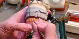 Introduction: The Importance of Precision in Full-Arch Restorations Full-arch implant restorations are among the most rewarding yet demanding treatments in dentistry. Precision is critical because even the smallest misfit can compromise occlusion, esthetics, or implant longevity. Unlike single-unit crowns, full-arch cases involve multiple implants, complex occlusal forces, and high esthetic expectations. This is why labs play a central role, their ability to combine digital workflows, material expertise, and functional design directly impacts the predictability of treatment. Common Challenges in Full-Arch Implant Cases Full-arch restorations often face: Implant misalignment due to surgical inaccuracies. Occlusal discrepancies that cause fractures or discomfort. Acrylic fractures or wear in hybrid prostheses. Esthetic challenges, especially with lip support and smile line. Remakes and extended chair time when frameworks don’t fit. In Minnesota labs, technicians note that many of these issues arise from incomplete case information or a lack of synchronization between the surgical and restorative teams. The Role of the Dental Lab in Ensuring Accurate Fit The lab is not just a manufacturer; it’s a co-designer of the case. By analyzing scan data, confirming implant positions, and checking occlusion virtually, labs ensure frameworks fit passively and prostheses function as intended. Passive fit is crucial, without it, stress transfers to the implants, potentially leading to peri-implant complications. Labs often run verification jigs, printed prototypes, or try-in frameworks before finalizing to guarantee accuracy. Digital Workflows: Scanning, Design, and 3D Printing for Full-Arch Cases Digital dentistry has transformed full-arch workflows. Instead of relying on stone casts and manual indexing, clinicians now capture intraoral scans, which are paired with CBCT data to design restorations digitally. Labs use CAD/CAM software to create frameworks, test occlusion virtually, and fabricate prototypes through 3D printing. This digital loop allows for fewer errors, faster turnaround, and more predictable results. In my view, digital workflows also enhance collaboration, dentists and labs can review designs remotely before final milling or printing. Material Selection: Zirconia, Hybrid, and Acrylic Options Choosing the right material depends on patient needs: Zirconia: Strong, durable, and esthetically advanced with multilayer translucency. Excellent for patients seeking long-term results with minimal maintenance. Hybrid (zirconia or metal framework with acrylic overlay): A balance between strength and repairability, but prone to acrylic wear over time. Acrylic: More affordable and lighter, but higher risk of fractures and staining. Often used for provisional or transitional cases. Labs guide dentists in selecting the material that aligns with functional demands, esthetic expectations, and cost considerations. Reducing Chair Time and Remakes Through Lab Collaboration Remakes are costly in time, money, and patient trust. Labs help reduce them by verifying occlusion digitally, running fit checks, and fabricating provisional prostheses before final delivery. A lab-driven workflow means fewer adjustments chairside, saving dentists chair time and patients unnecessary appointments. Many clinicians in Minnesota report that consistent communication with the lab drastically cuts down on remakes and last-minute surprises. Case Planning: How Dental Labs Support Predictable Outcomes Labs participate in planning from the very beginning: Reviewing CBCT scans and implant positioning. Designing surgical guides for optimal placement. Providing provisional prostheses that guide esthetics and occlusion. Assisting in full-arch mock-ups so patients can preview their final smile. This collaboration ensures that when the prosthesis is delivered, it meets both functional and esthetic goals. Communication Between Dentist and Lab The success of full-arch cases often hinges on communication. Labs need detailed digital impressions, bite records, facial photos, and notes about patient expectations. Clear, ongoing communication ensures fewer errors and better case outcomes. Many labs prefer scheduled “check-in” calls during complex cases so adjustments can be made early in the process. Patient Satisfaction: How Lab Precision Impacts Comfort and Aesthetics When labs deliver precise prostheses, patients feel the difference immediately. A proper bite reduces soreness and fractures, while accurate esthetics boost confidence and satisfaction. A poorly fitting arch, on the other hand, causes discomfort, speech problems, and costly adjustments. Lab precision directly translates into comfort, function, and long-term happiness for patients. Partnering with a Skilled Lab for Full-Arch Excellence (mention CDL) Not all labs are equally equipped for full-arch implant cases. Partnering with a Certified Dental Laboratory (CDL) ensures that technicians are trained, certified, and experienced in advanced workflows. CDL labs in Minnesota, for example, emphasize quality standards, digital integration, and ongoing training. For dentists, this partnership means they can rely on lab expertise for case planning, troubleshooting, and delivering prostheses that consistently meet high expectations.