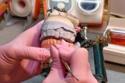 Introduction: The Importance of Precision in Full-Arch Restorations Full-arch implant restorations are among the most rewarding yet demanding treatments in dentistry. Precision is critical because even the smallest misfit can compromise occlusion, esthetics, or implant longevity. Unlike single-unit crowns, full-arch cases involve multiple implants, complex occlusal forces, and high esthetic expectations. This is why labs play a central role, their ability to combine digital workflows, material expertise, and functional design directly impacts the predictability of treatment. Common Challenges in Full-Arch Implant Cases Full-arch restorations often face: Implant misalignment due to surgical inaccuracies. Occlusal discrepancies that cause fractures or discomfort. Acrylic fractures or wear in hybrid prostheses. Esthetic challenges, especially with lip support and smile line. Remakes and extended chair time when frameworks don’t fit. In Minnesota labs, technicians note that many of these issues arise from incomplete case information or a lack of synchronization between the surgical and restorative teams. The Role of the Dental Lab in Ensuring Accurate Fit The lab is not just a manufacturer; it’s a co-designer of the case. By analyzing scan data, confirming implant positions, and checking occlusion virtually, labs ensure frameworks fit passively and prostheses function as intended. Passive fit is crucial, without it, stress transfers to the implants, potentially leading to peri-implant complications. Labs often run verification jigs, printed prototypes, or try-in frameworks before finalizing to guarantee accuracy. Digital Workflows: Scanning, Design, and 3D Printing for Full-Arch Cases Digital dentistry has transformed full-arch workflows. Instead of relying on stone casts and manual indexing, clinicians now capture intraoral scans, which are paired with CBCT data to design restorations digitally. Labs use CAD/CAM software to create frameworks, test occlusion virtually, and fabricate prototypes through 3D printing. This digital loop allows for fewer errors, faster turnaround, and more predictable results. In my view, digital workflows also enhance collaboration, dentists and labs can review designs remotely before final milling or printing. Material Selection: Zirconia, Hybrid, and Acrylic Options Choosing the right material depends on patient needs: Zirconia: Strong, durable, and esthetically advanced with multilayer translucency. Excellent for patients seeking long-term results with minimal maintenance. Hybrid (zirconia or metal framework with acrylic overlay): A balance between strength and repairability, but prone to acrylic wear over time. Acrylic: More affordable and lighter, but higher risk of fractures and staining. Often used for provisional or transitional cases. Labs guide dentists in selecting the material that aligns with functional demands, esthetic expectations, and cost considerations. Reducing Chair Time and Remakes Through Lab Collaboration Remakes are costly in time, money, and patient trust. Labs help reduce them by verifying occlusion digitally, running fit checks, and fabricating provisional prostheses before final delivery. A lab-driven workflow means fewer adjustments chairside, saving dentists chair time and patients unnecessary appointments. Many clinicians in Minnesota report that consistent communication with the lab drastically cuts down on remakes and last-minute surprises. Case Planning: How Dental Labs Support Predictable Outcomes Labs participate in planning from the very beginning: Reviewing CBCT scans and implant positioning. Designing surgical guides for optimal placement. Providing provisional prostheses that guide esthetics and occlusion. Assisting in full-arch mock-ups so patients can preview their final smile. This collaboration ensures that when the prosthesis is delivered, it meets both functional and esthetic goals. Communication Between Dentist and Lab The success of full-arch cases often hinges on communication. Labs need detailed digital impressions, bite records, facial photos, and notes about patient expectations. Clear, ongoing communication ensures fewer errors and better case outcomes. Many labs prefer scheduled “check-in” calls during complex cases so adjustments can be made early in the process. Patient Satisfaction: How Lab Precision Impacts Comfort and Aesthetics When labs deliver precise prostheses, patients feel the difference immediately. A proper bite reduces soreness and fractures, while accurate esthetics boost confidence and satisfaction. A poorly fitting arch, on the other hand, causes discomfort, speech problems, and costly adjustments. Lab precision directly translates into comfort, function, and long-term happiness for patients. Partnering with a Skilled Lab for Full-Arch Excellence (mention CDL) Not all labs are equally equipped for full-arch implant cases. Partnering with a Certified Dental Laboratory (CDL) ensures that technicians are trained, certified, and experienced in advanced workflows. CDL labs in Minnesota, for example, emphasize quality standards, digital integration, and ongoing training. For dentists, this partnership means they can rely on lab expertise for case planning, troubleshooting, and delivering prostheses that consistently meet high expectations.