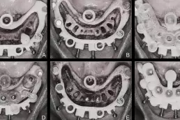 Stackable Surgical Guides